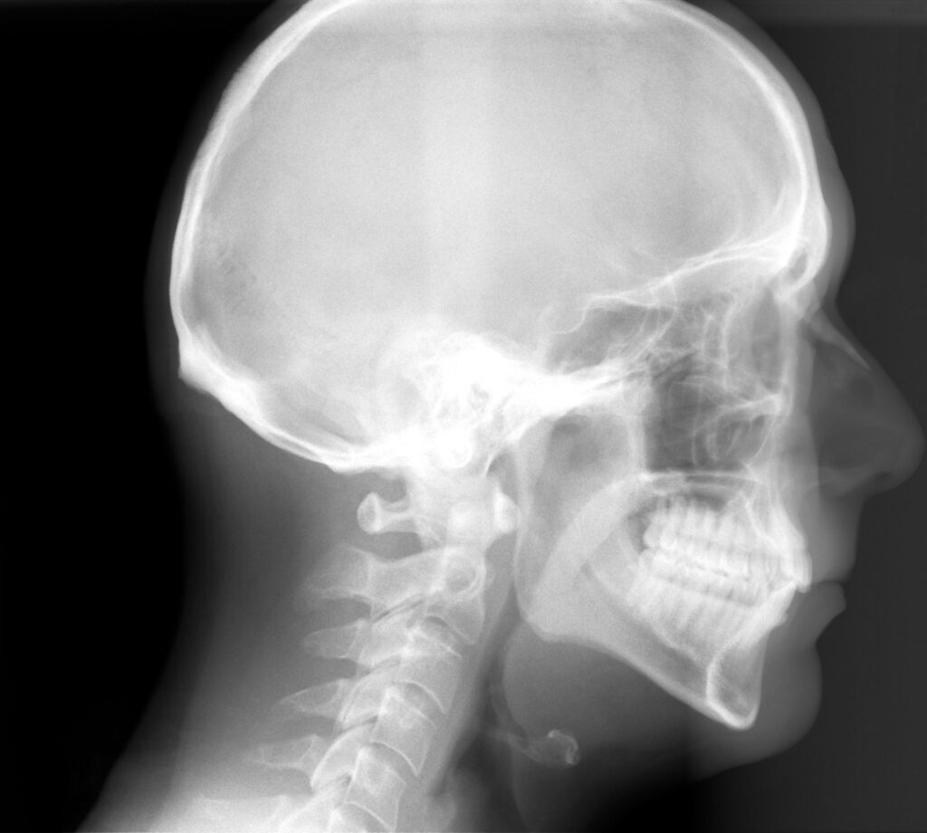 Cephalometric X-ray of the skull and jaw used to diagnose skeletal vs dental overbite